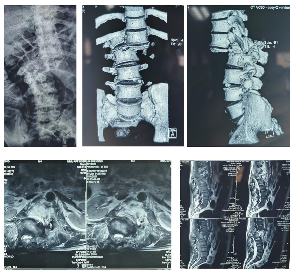 1614767033630008612.jpg 腰椎骨折Ⅳ°脱位(1)_01_副本.jpg