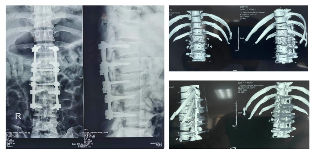 1614767116901044493.jpg 腰椎骨折Ⅳ°脱位(1)_02_副本.jpg